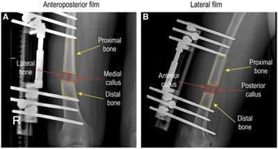 The early posterior cortex pixel value ratio: a novel reliable indicator for distraction osteogenesis